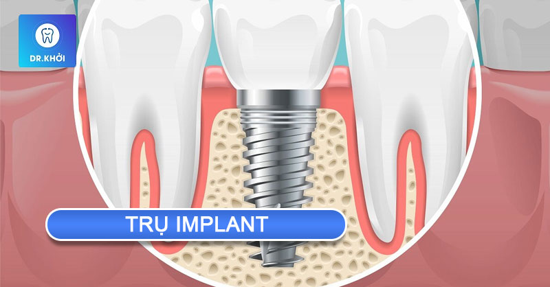 trụ implant