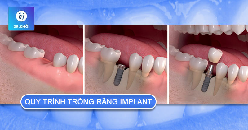 quy trình trồng răng implant